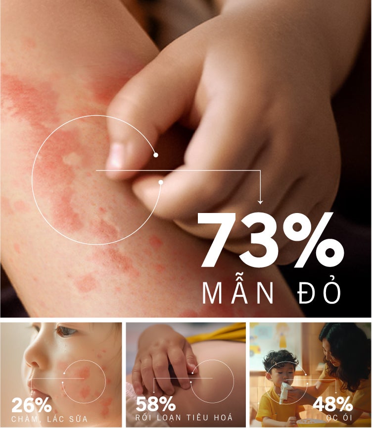 73% trẻ Việt Nam gặp phải triệu chứng mẫn cảm