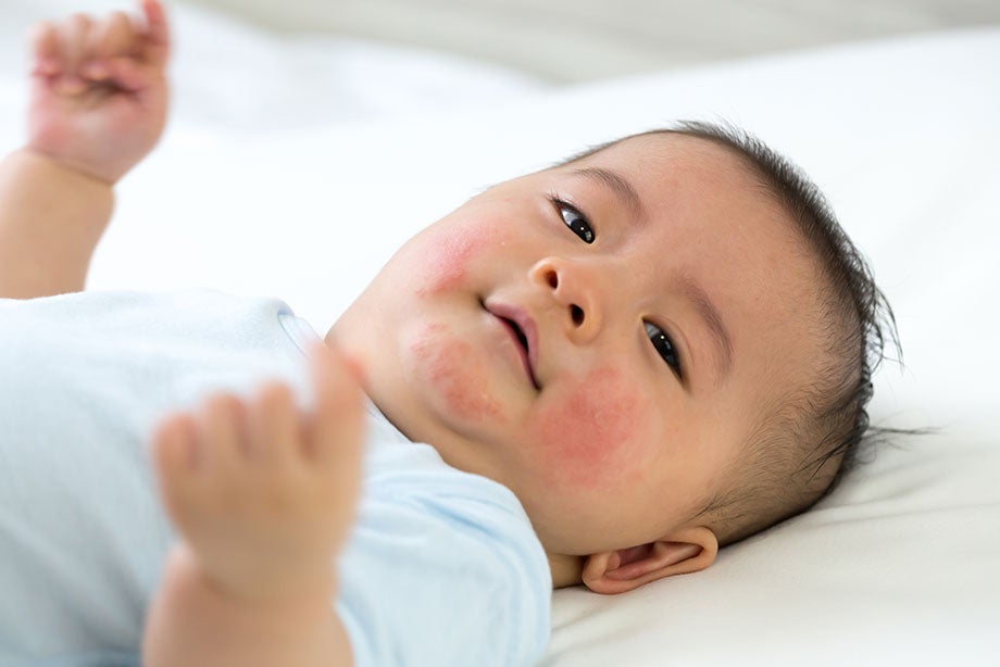 Hệ miễn dịch của bé phản ứng với thành phần đạm có trong sữa bò và chế phẩm từ sữa bò gây ra dị ứng đạm sữa bò sữa