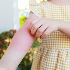 trẻ bị mẫn cảm trẻ bị mẫn cảm
