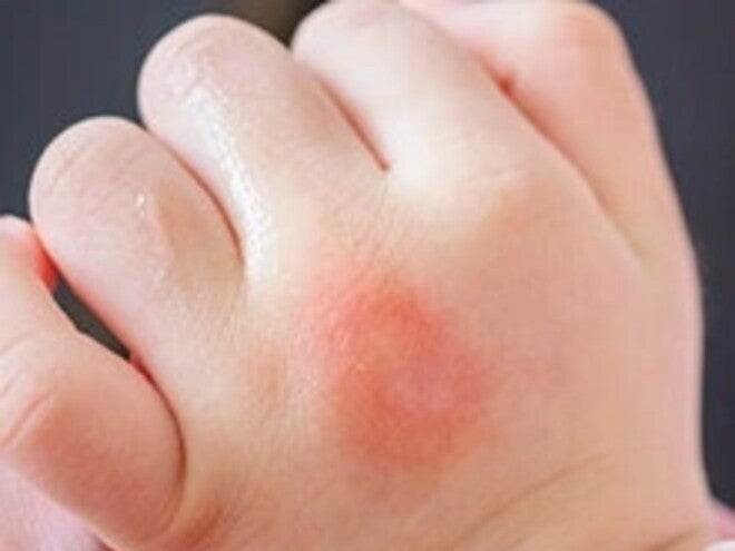 Mẫn đỏ Mẫn đỏ